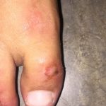 Injured foot at Koh Lanta, Thailand. A welcome break in Koh Lanta & a foot