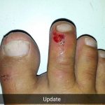 Injured foot at Koh Lanta, Thailand. A welcome break in Koh Lanta & a foot